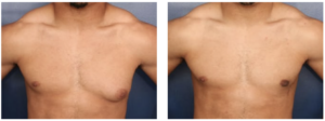 Before and after of muscular man who had successful gynecomastia surgery